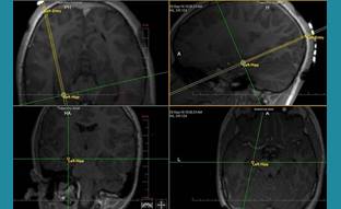 Minimally Invasive Technology in Epilepsy Procedures